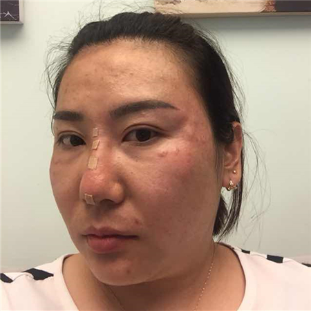 注射注射瘦臉去魚尾紋前后對比果照片分享，大同清木姜際珠做的~