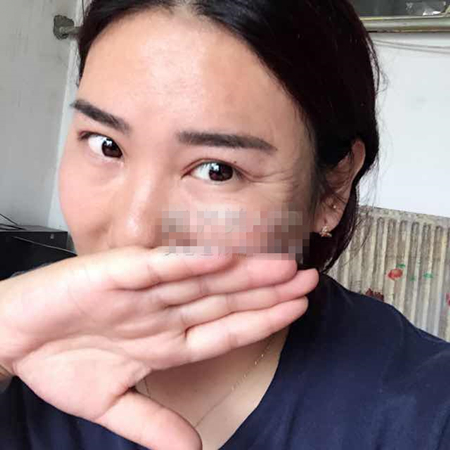 注射注射瘦臉去魚尾紋前后對比果照片分享，大同清木姜際珠做的~