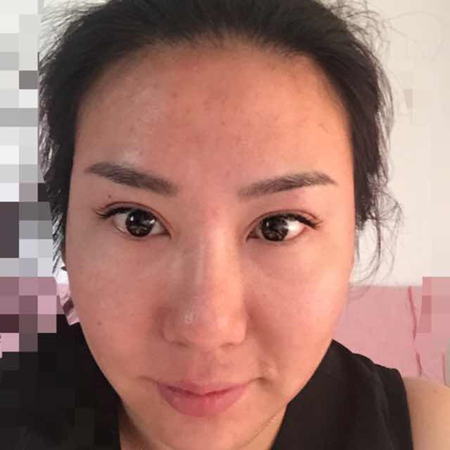 注射注射瘦臉去魚尾紋前后對比果照片分享，大同清木姜際珠做的~