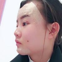 自體脂肪面部填充恢復(fù)過程分享，填充價(jià)格12000元