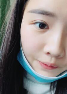 自體脂肪面部填充恢復(fù)一個月