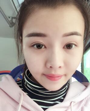 這就是我對自體脂肪面部填充恢復(fù)過程的簡單分享