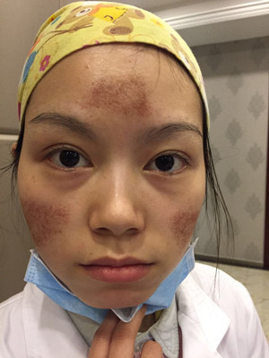 點(diǎn)陣激光祛痘前后過程對(duì)比照片分享，大家來看看果怎么樣