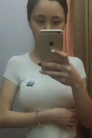 美國麥格假體隆胸術(shù)后恢復(fù)身材超贊