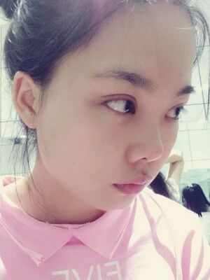 全切雙眼皮手術(shù)，送給自己的成年禮物