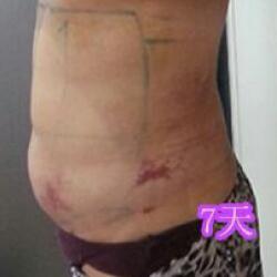 肚子減肥的方法就是吸脂減肥瘦腰腹了，親身經(jīng)歷分享