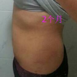 肚子減肥的方法就是吸脂減肥瘦腰腹了，親身經(jīng)歷分享