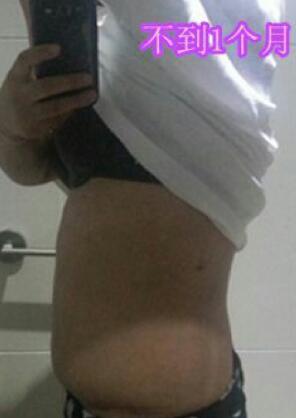 吸脂減肥瘦腰腹術(shù)后近一個月恢復(fù)果