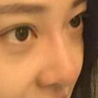 為什么大家覺得隆鼻恐怖，我就做了玻尿酸隆鼻，過程經(jīng)歷分享
