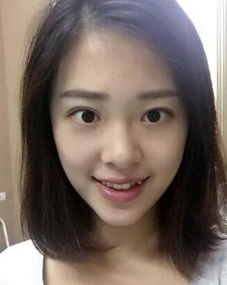 玻尿酸隆鼻前
