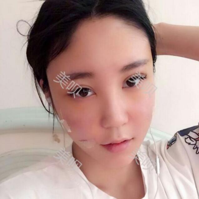 自體脂肪豐蘋(píng)果肌后我凹陷顯老的面部終于變得年輕啦