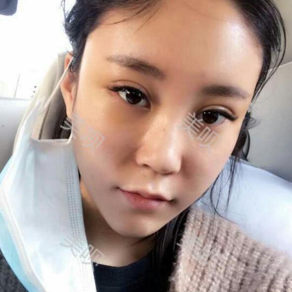 自體脂肪豐蘋(píng)果肌后我凹陷顯老的面部終于變得年輕啦