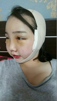 顴骨整形手術后，我也可以擁有精致小臉了