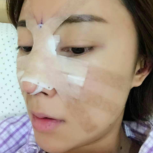 這個(gè)月剛做了駝峰鼻矯正整形手術(shù)，分享術(shù)前術(shù)后的照片~
