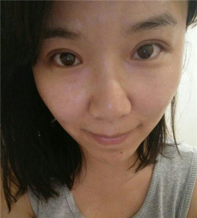紅藍光祛痘手術恢復過程分享，還有前后對比果圖片哦~