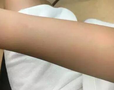 激光脫毛后