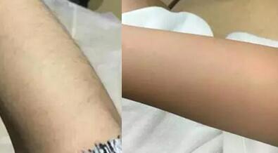 第(一)次激光脫毛緩解后的前后對(duì)比圖