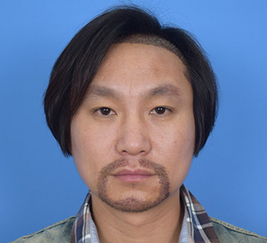 種植胡須手術(shù)前后過程以及對比照片分享