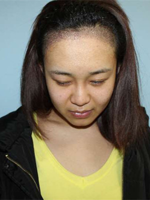 做了發(fā)際線種植手術(shù)，感覺還不錯!