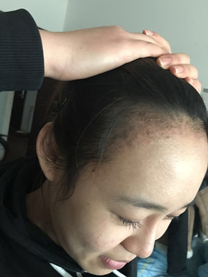 做了發(fā)際線種植手術(shù)，感覺還不錯!