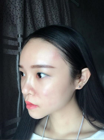 我的自體脂肪填充下巴+蘋果肌的恢復(fù)過程 自體脂肪真的是一個(gè)好東西