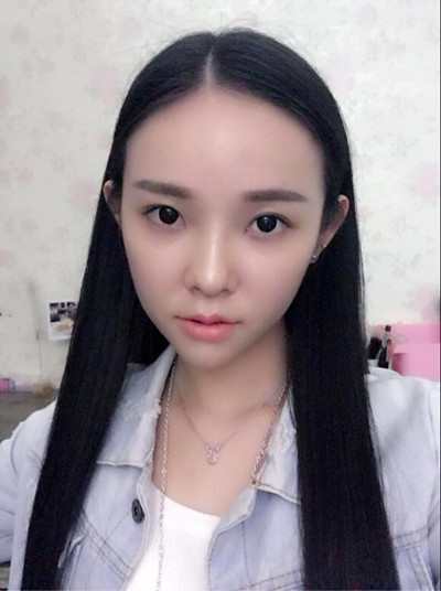 我的自體脂肪填充下巴+蘋果肌的恢復(fù)過程 自體脂肪真的是一個(gè)好東西