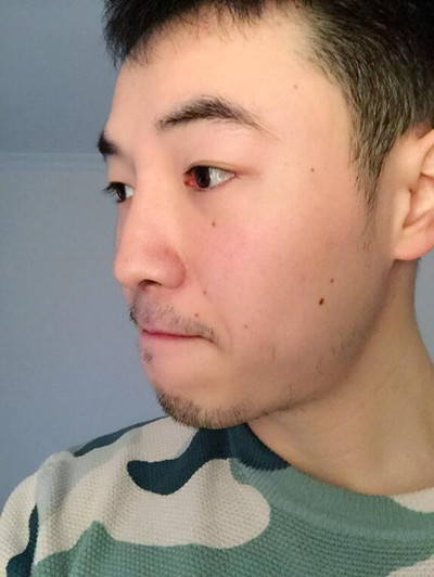 我的隆鼻整形案例恢復(fù)過程 大老爺們也有一個愛沒的心