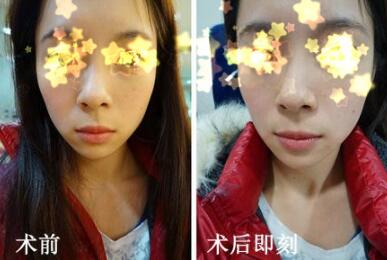 玻尿酸填充法令紋前后對比圖