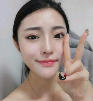隆鼻整形1個月真實(shí)恢復(fù)期圖片