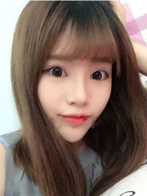 耳軟骨墊鼻尖+硅膠假體隆鼻前后對比，變化是不是很大