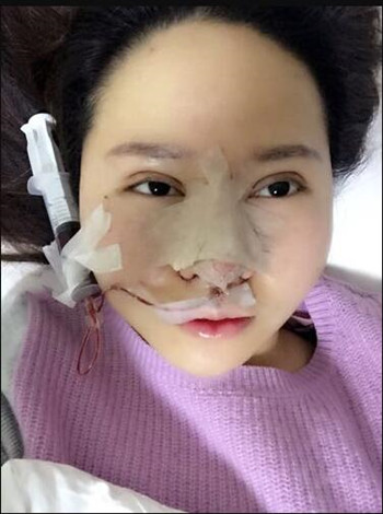 大鼻子就得做隆鼻整形手術(shù)改良 我的果就挺不錯的