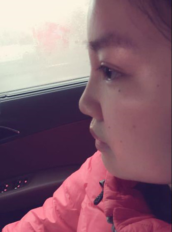 我的隆鼻整形恢復時的那些事