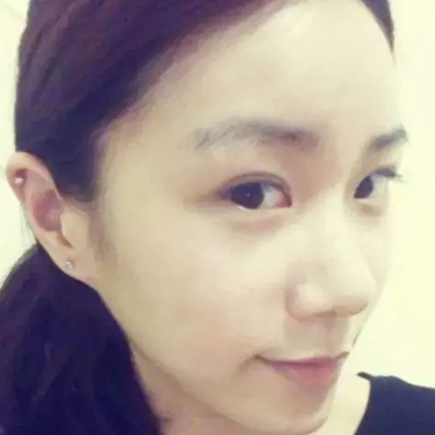 隆鼻整形+雙眼皮手術(shù)兩個月了，分享恢復(fù)前后對比果照片~