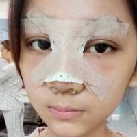 隆鼻整形恢復(fù)日記分享，整形價格8800元