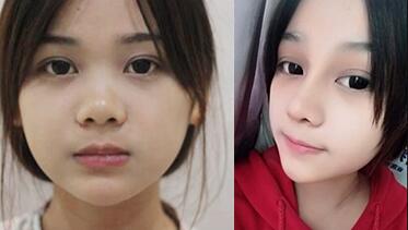 隆鼻整形前后對比圖如下