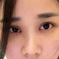 全切雙眼皮價格6800元，無神小眼變光彩大雙眼恢復(fù)過程分享