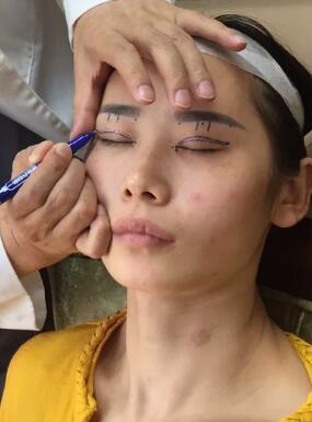 割雙眼皮術(shù)前設(shè)計(jì)圖