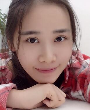 割雙眼皮一個(gè)半月了,雙眼皮完全恢復(fù)自然