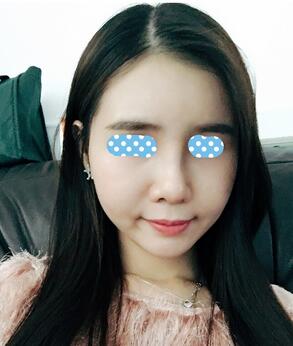 自體脂肪填充后2個月圖