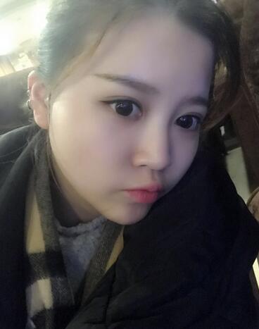 雙眼皮+開眼角3個月恢復(fù)過程圖