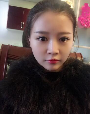 雙眼皮+開眼角3個月恢復(fù)過程圖