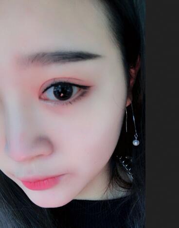 雙眼皮+開眼角3個月恢復(fù)過程圖