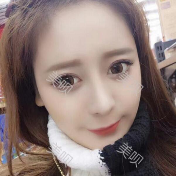 硅膠假體隆鼻+鼻翼縮小術后一個月恢復過程