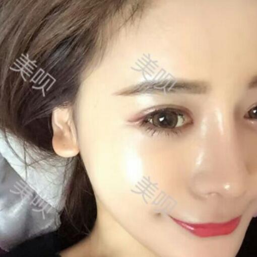 硅膠假體隆鼻+鼻翼縮小術后一個月恢復過程