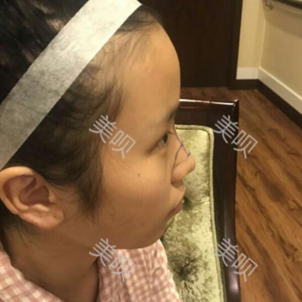 玻尿酸隆鼻前后對比照分享瞬間提升氣質了哦