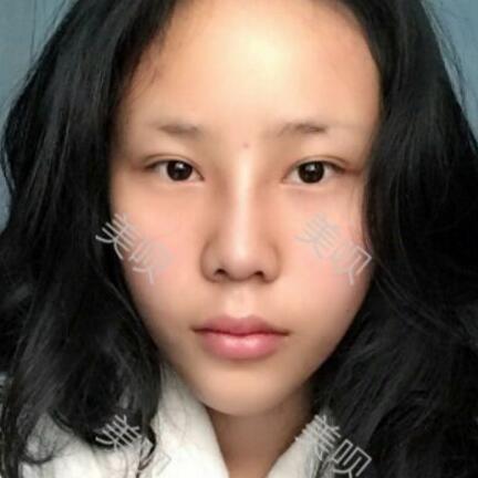 玻尿酸隆鼻前后對比照分享瞬間提升氣質了哦