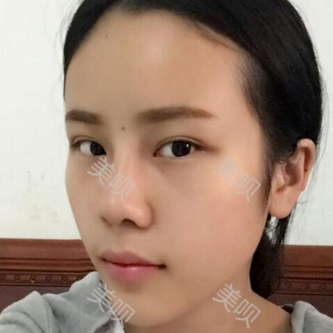 玻尿酸隆鼻前后對比照分享瞬間提升氣質了哦