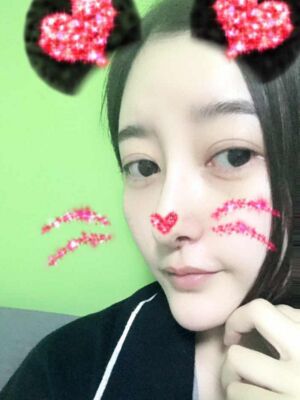 硅膠隆鼻+去眼袋前后對比果十分明X