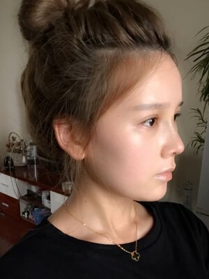 隆鼻和雙眼皮修復一起做的，現(xiàn)在氣質提升好多