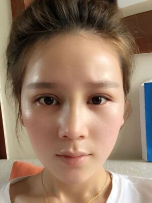 隆鼻和雙眼皮修復一起做的，現(xiàn)在氣質提升好多
